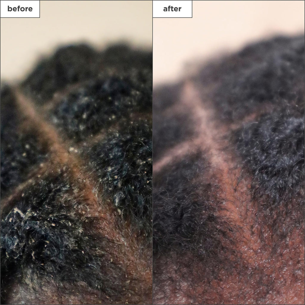 Briogeo Scalp Revival Charcoal + Tea Tree Scalp Treatment | Leave-In Serum